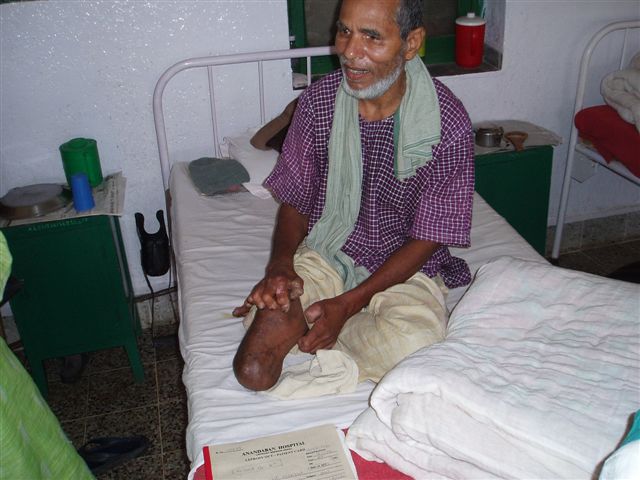 leg_and_fingers_gone_due_to_leprosy.jpg