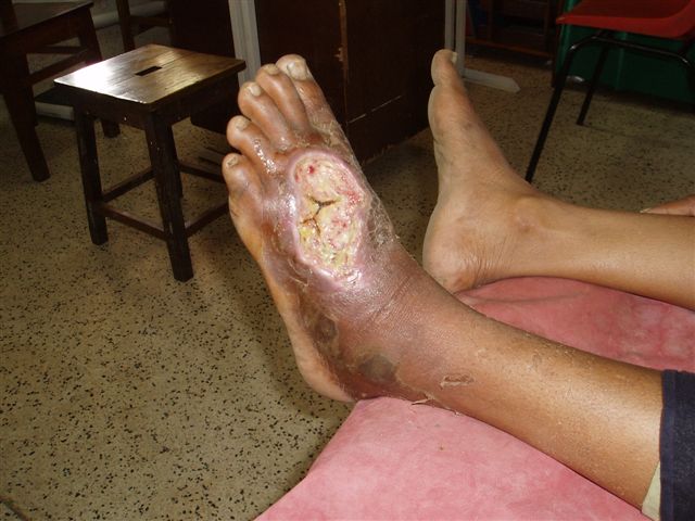 e2_urmila_s_cobra_bite1_after_1_month.jpg